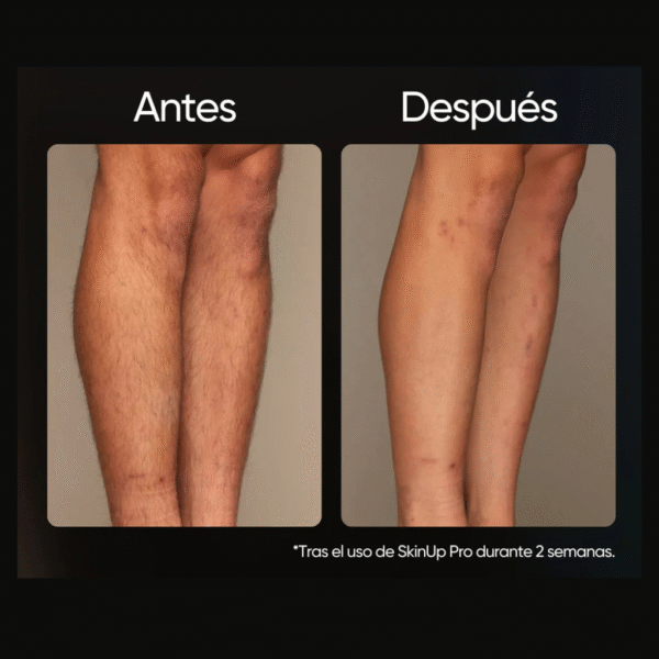 Láser permanente - Skinup Pro